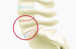 lumbar-osteoarthritis-01